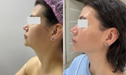 Дермотония FULLSKIN Дермотония FULLSKIN